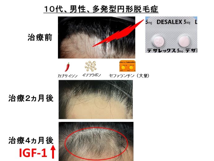 円形脱毛症　病院